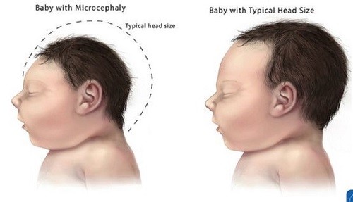 Virus Zika vào Việt Nam, phụ nữ mang thai nên làm gì? Virus Zika vào Việt Nam, phụ nữ mang thai nên làm gì?